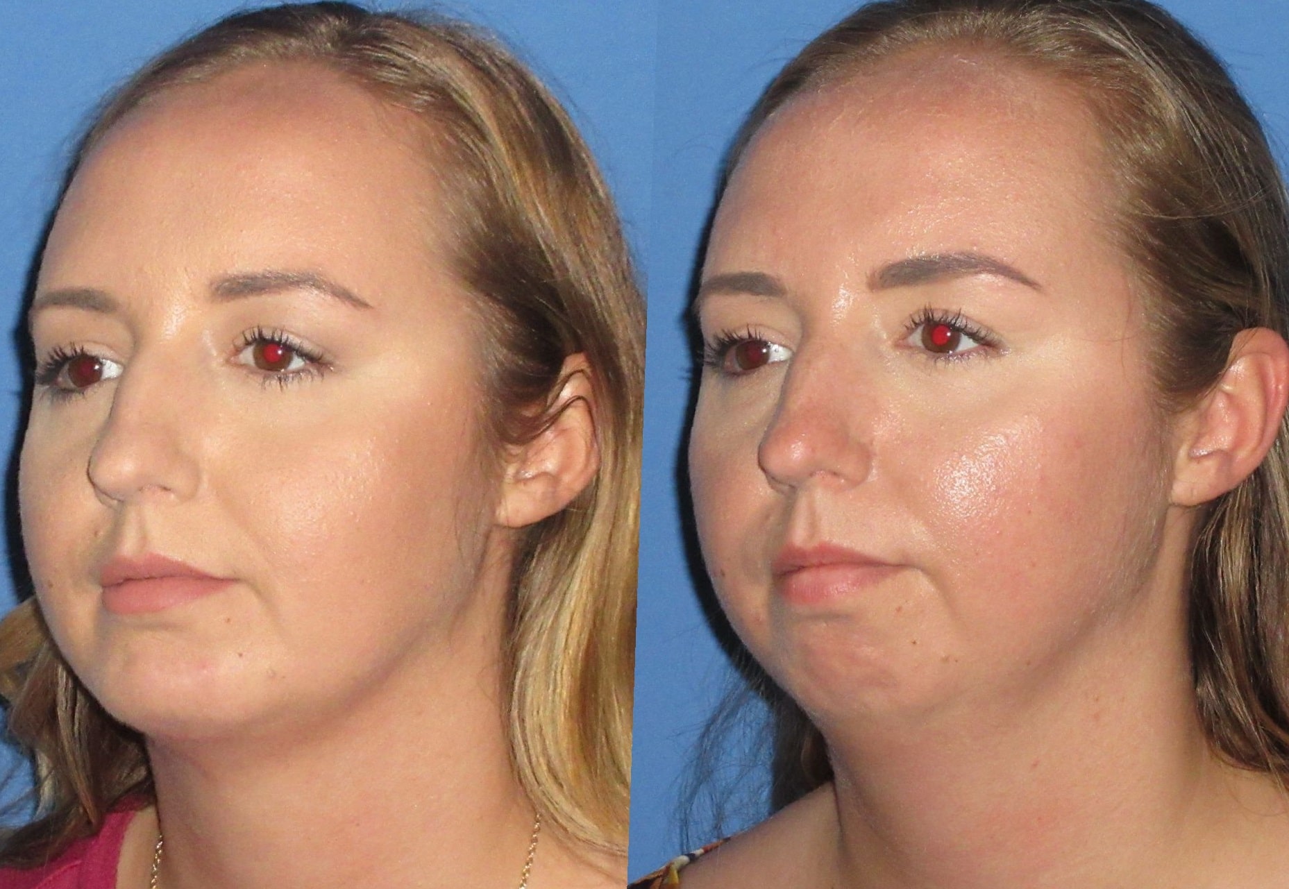 cheek-implants-before-and-after-3