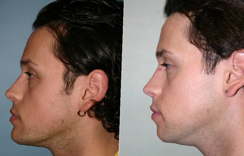 cheek-implants-before-and-after-4