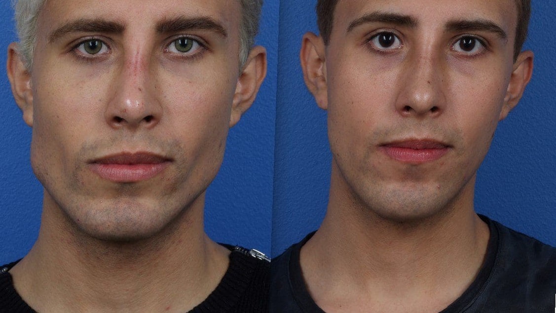 cheek-implants-before-and-after-5