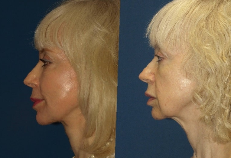 cheek-implants-before-and-after-6