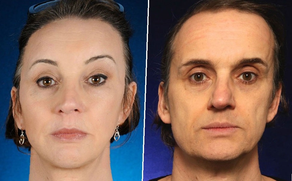 cheek-implants-before-and-after-7