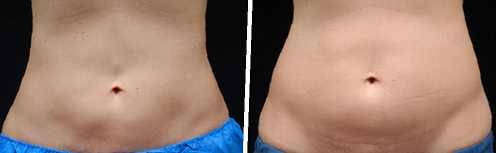 coolsculpting-before-and-after-stomach-1