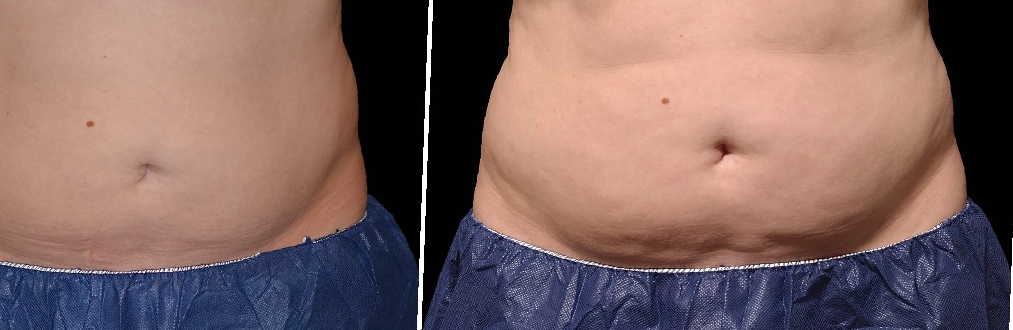coolsculpting-before-and-after-stomach-2
