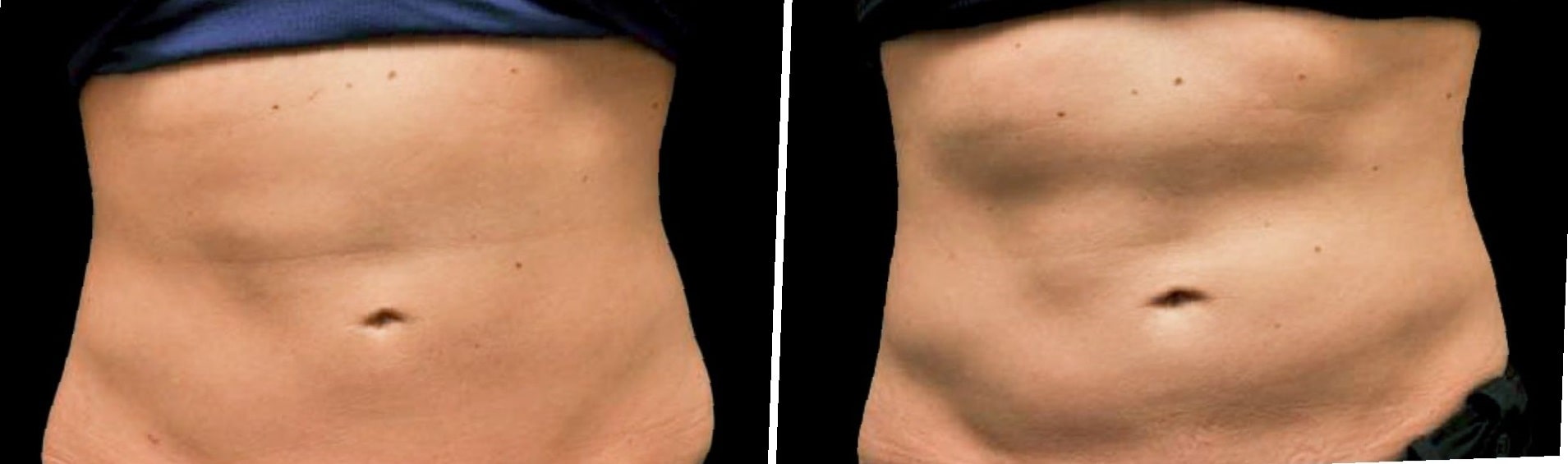 coolsculpting-before-and-after-stomach-3