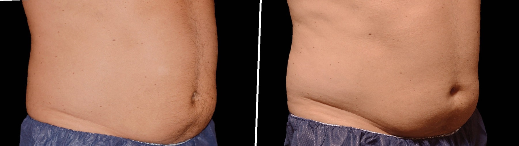 coolsculpting-before-and-after-stomach-4