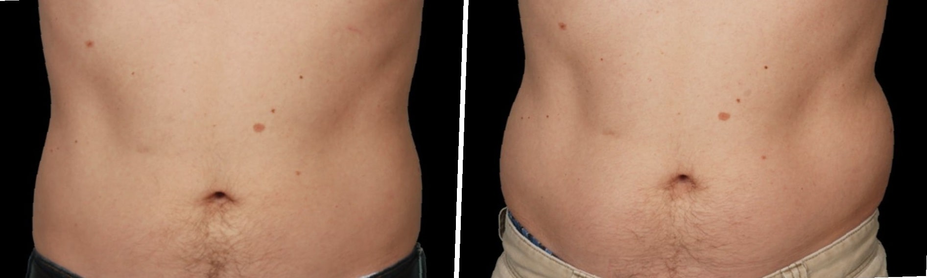 coolsculpting-before-and-after-stomach-5