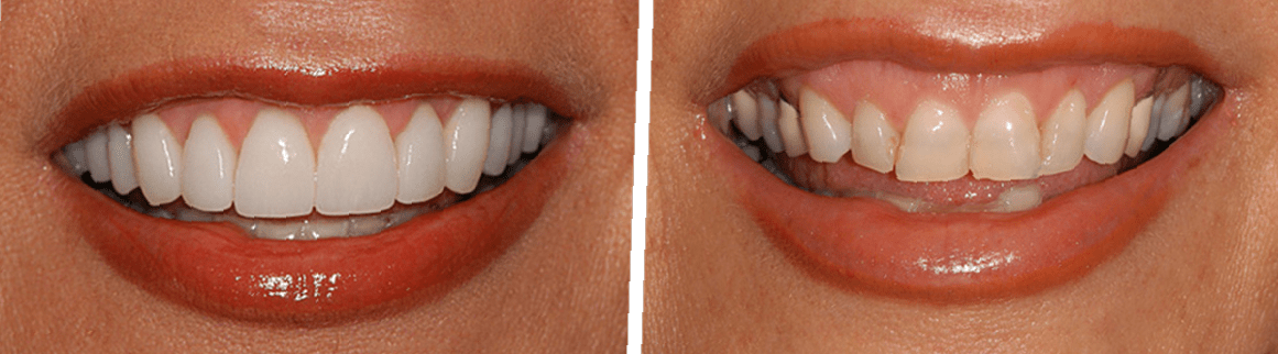 dental-bridge-before-and-after-6