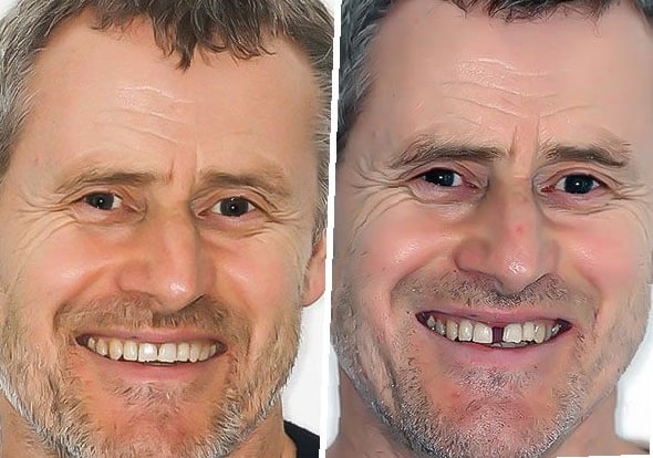 dental-bridge-before-and-after-7