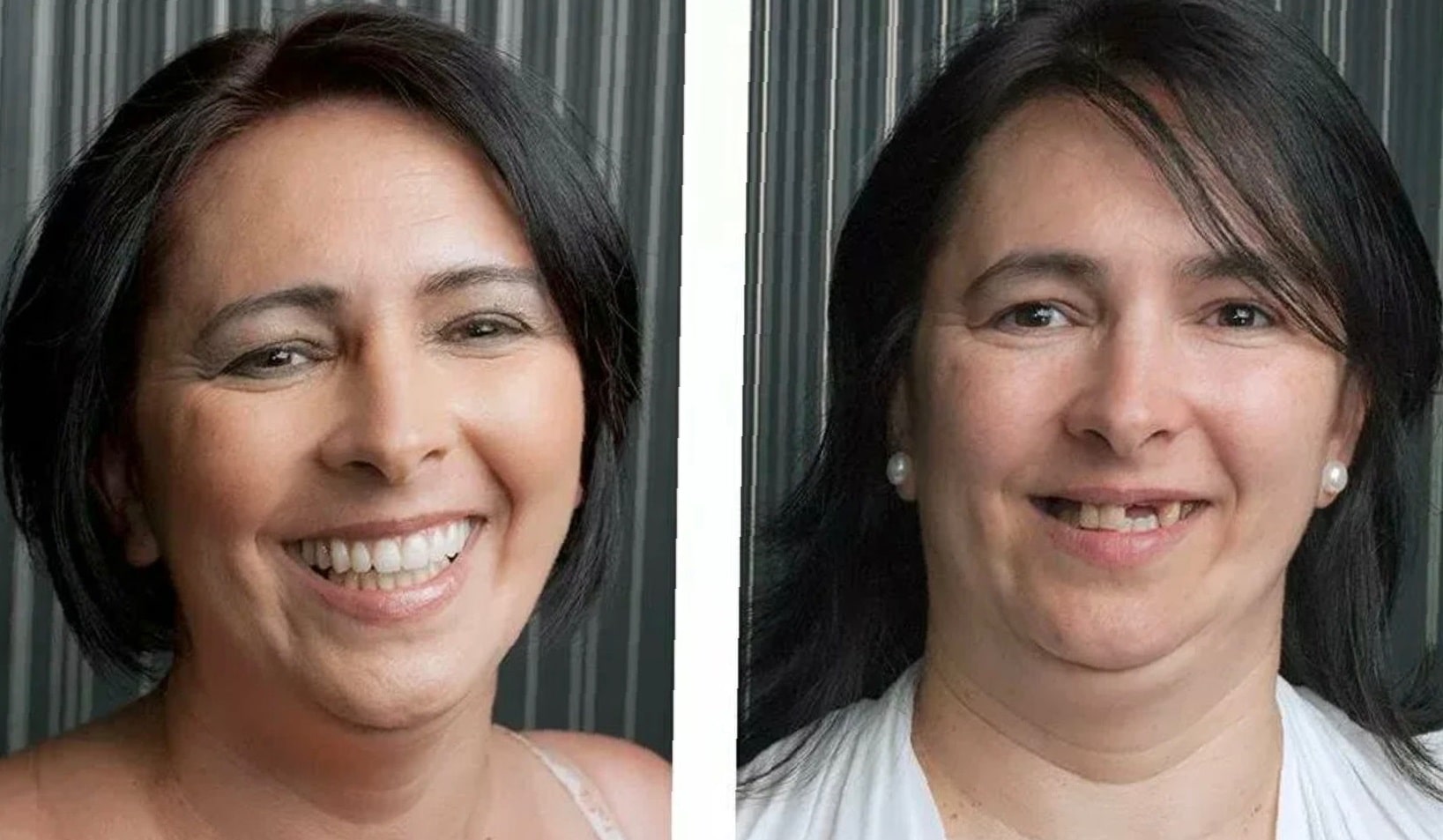 dental-implants-before-and-after-24