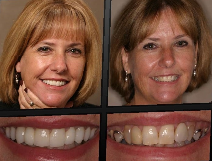 dental-implants-before-and-after-29