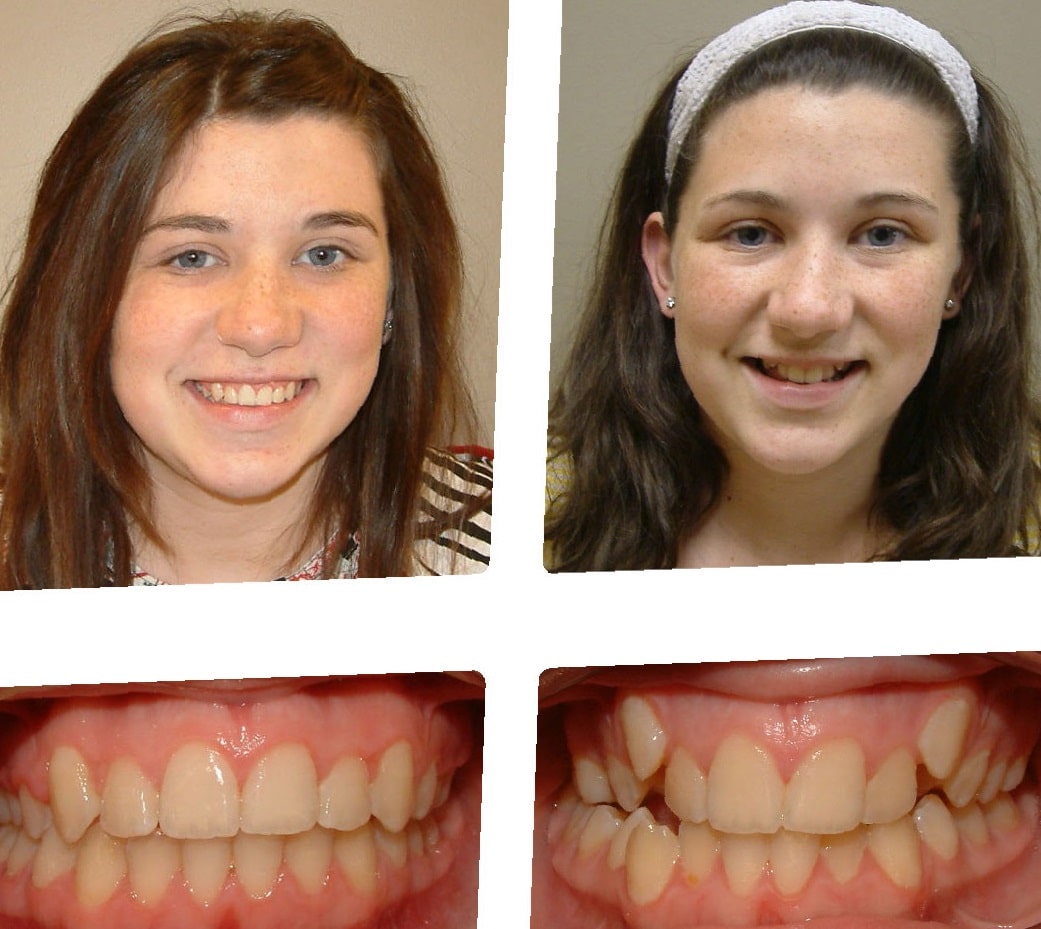 dental-implants-before-and-after-91