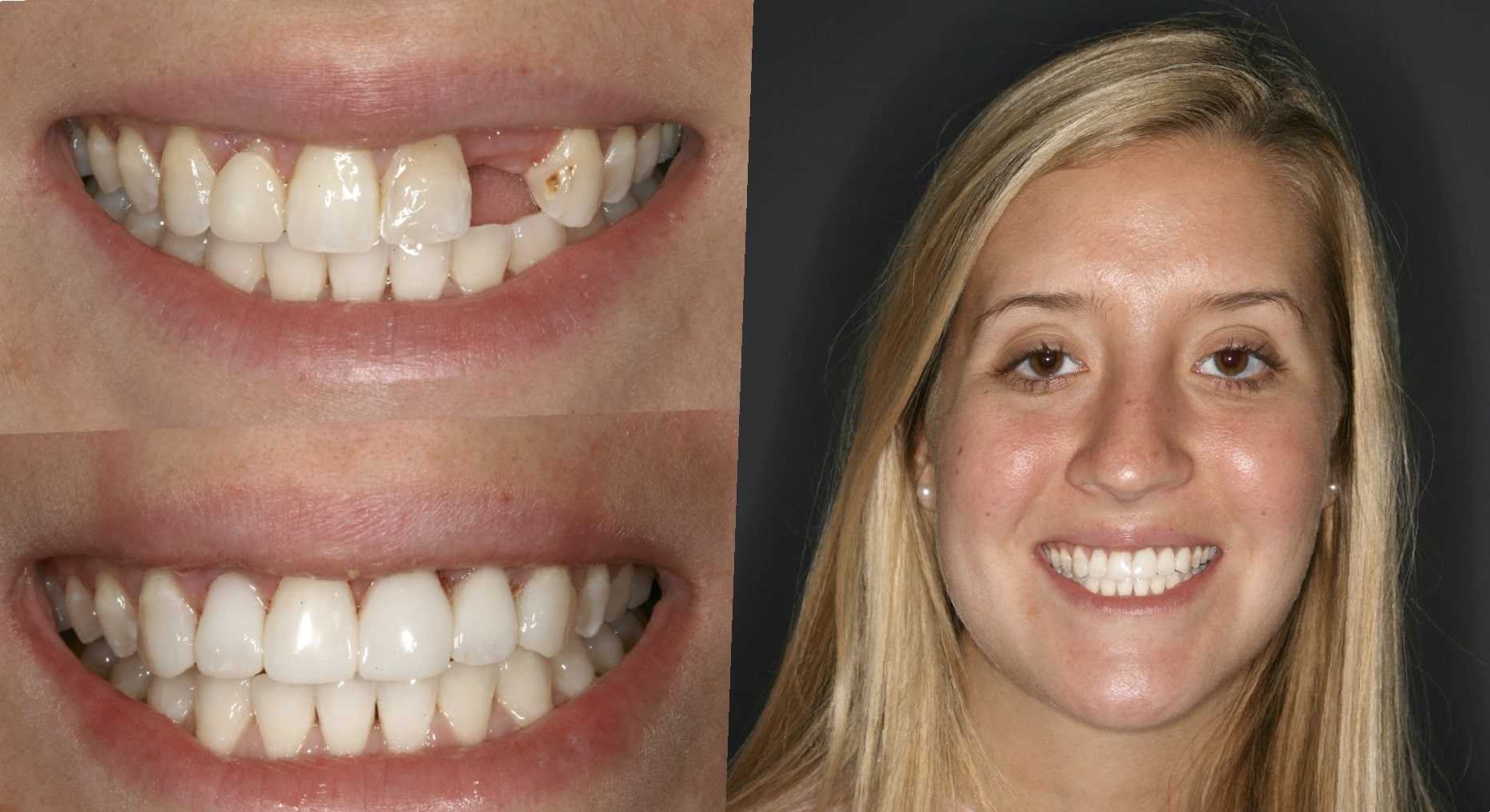 dental-implants-before-and-after-92