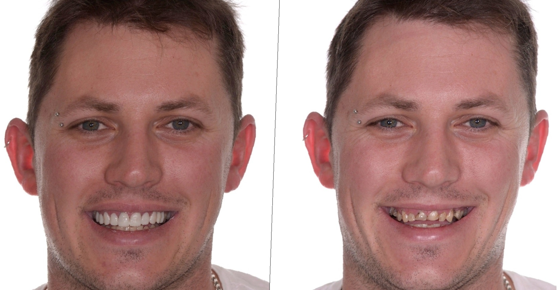 dental-implants-before-and-after-93
