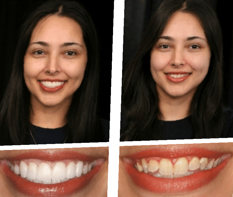 dental-implants-before-and-after-94