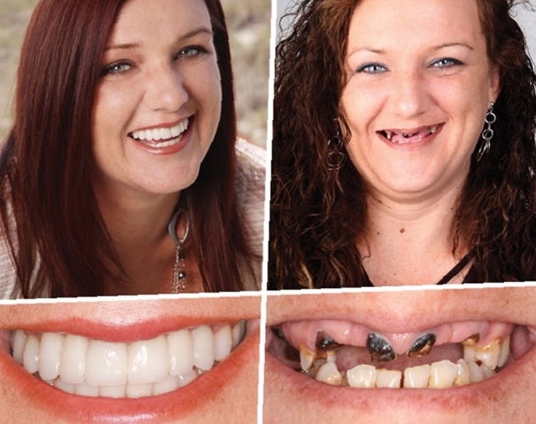 dental-implants-before-and-after-95