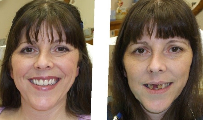 dental-implants-before-and-after-96
