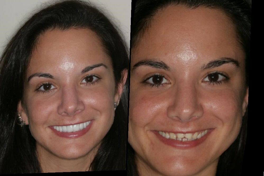 dental-implants-before-and-after-97