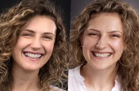 dental-implants-before-and-after-98