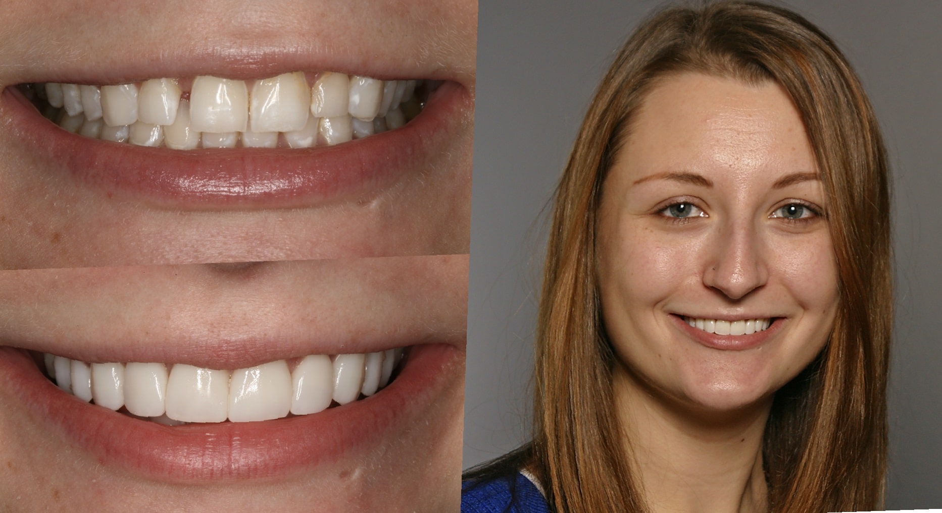 dental-implants-before-and-after-99