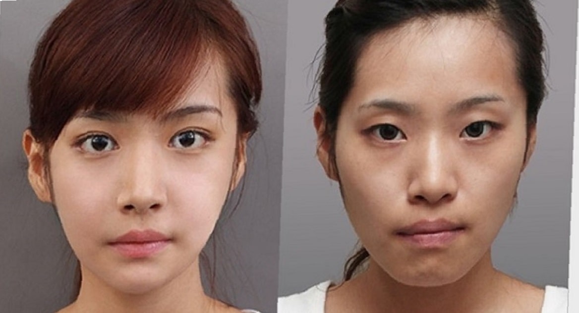 double-eyelid-surgery-before-and-after-3