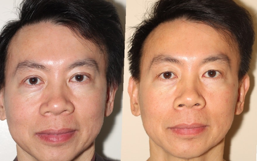 double-eyelid-surgery-before-and-after-4