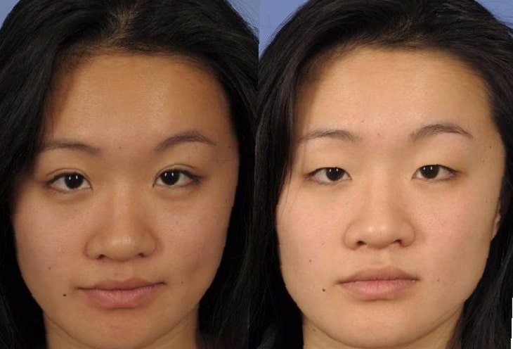 double-eyelid-surgery-before-and-after-5