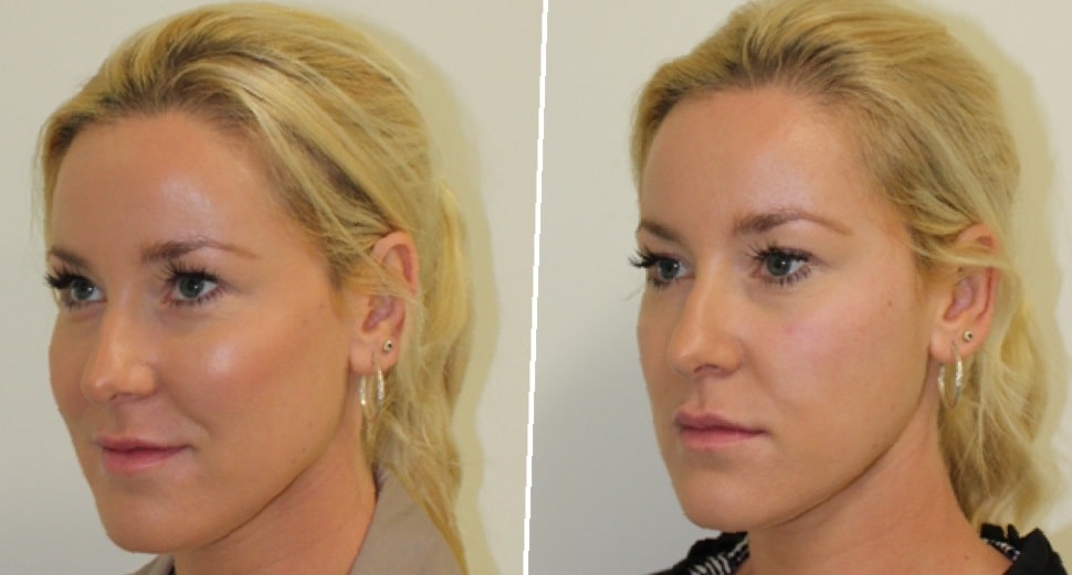 fillers-before-and-after-12