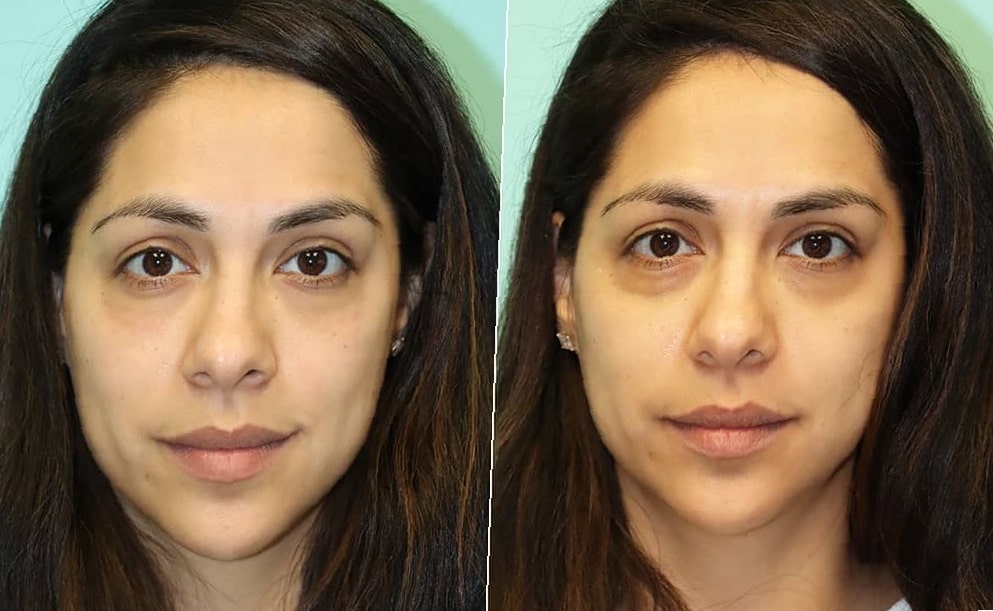 fillers-before-and-after-15