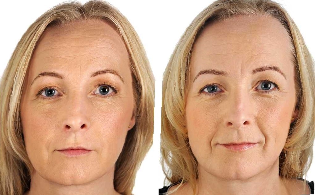 fillers-before-and-after-18
