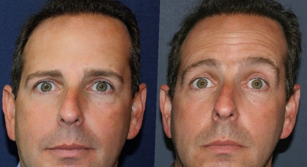 forehead-botox-before-and-after-37