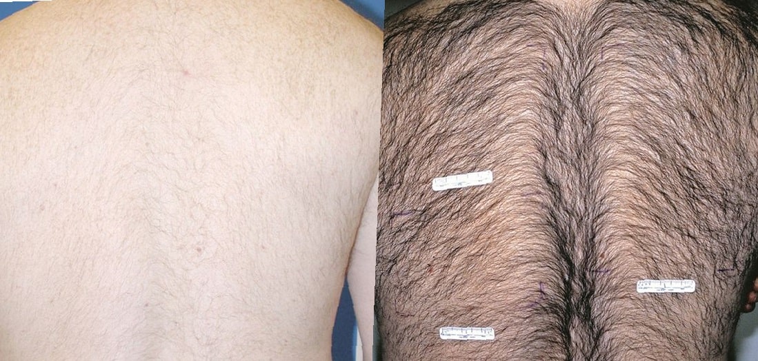 full-brazilian-laser-hair-removal-before-and-after-photos-1