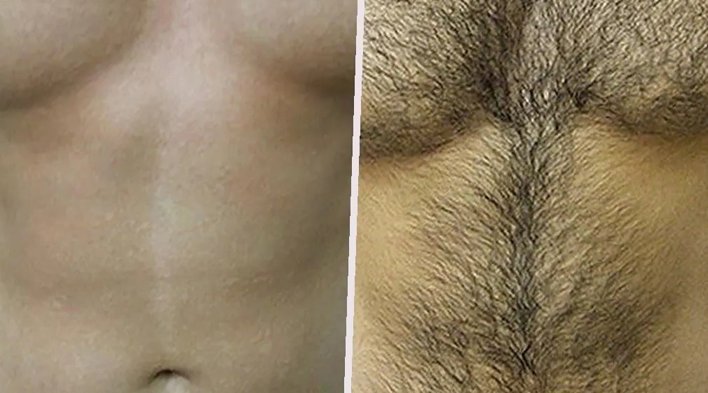 full-brazilian-laser-hair-removal-before-and-after-photos-2