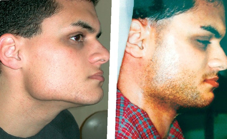 full-brazilian-laser-hair-removal-before-and-after-photos-3