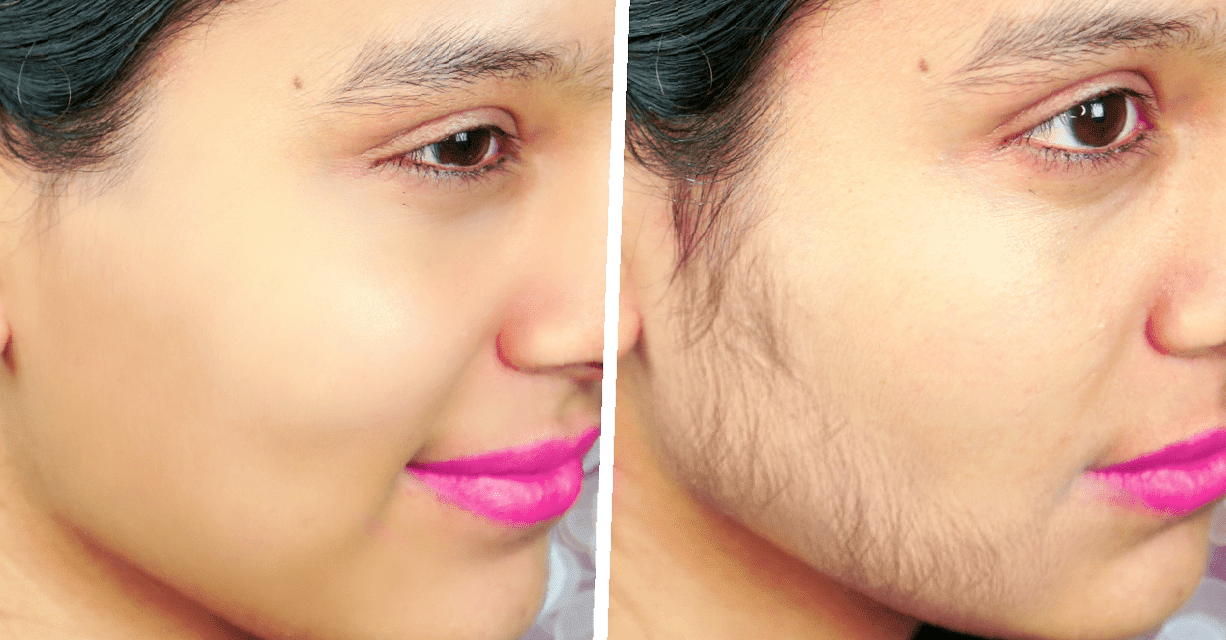Full Brazilian Laser Hair Removal Before and After Photos Revealed