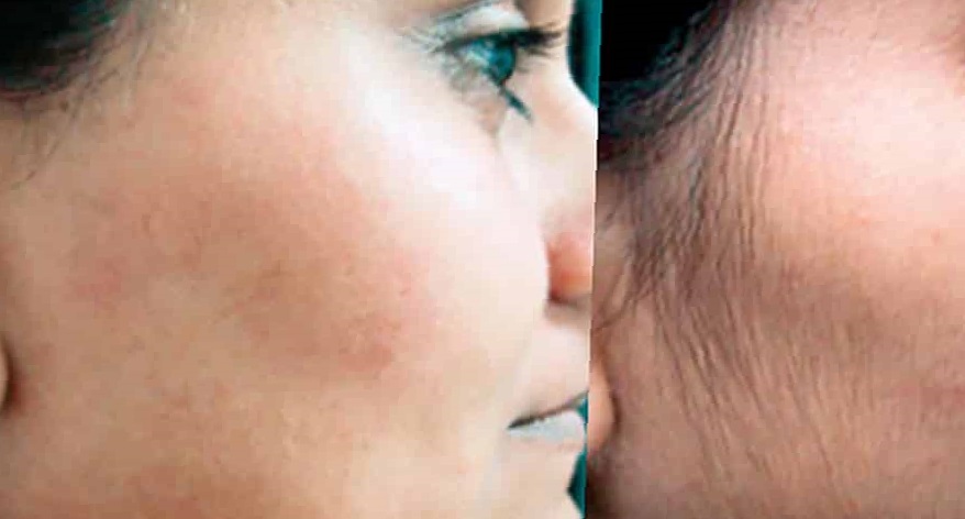 full-brazilian-laser-hair-removal-before-and-after-photos-5