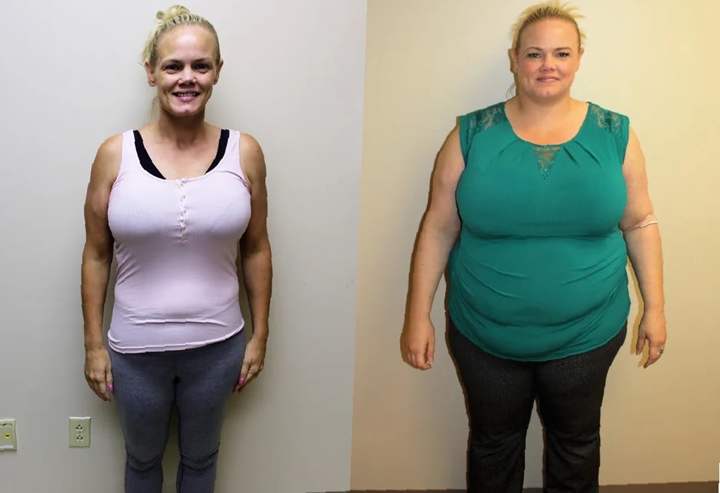 Gastric Sleeve Before And After A Comprehensive Guide Xbeforeandafter 5714