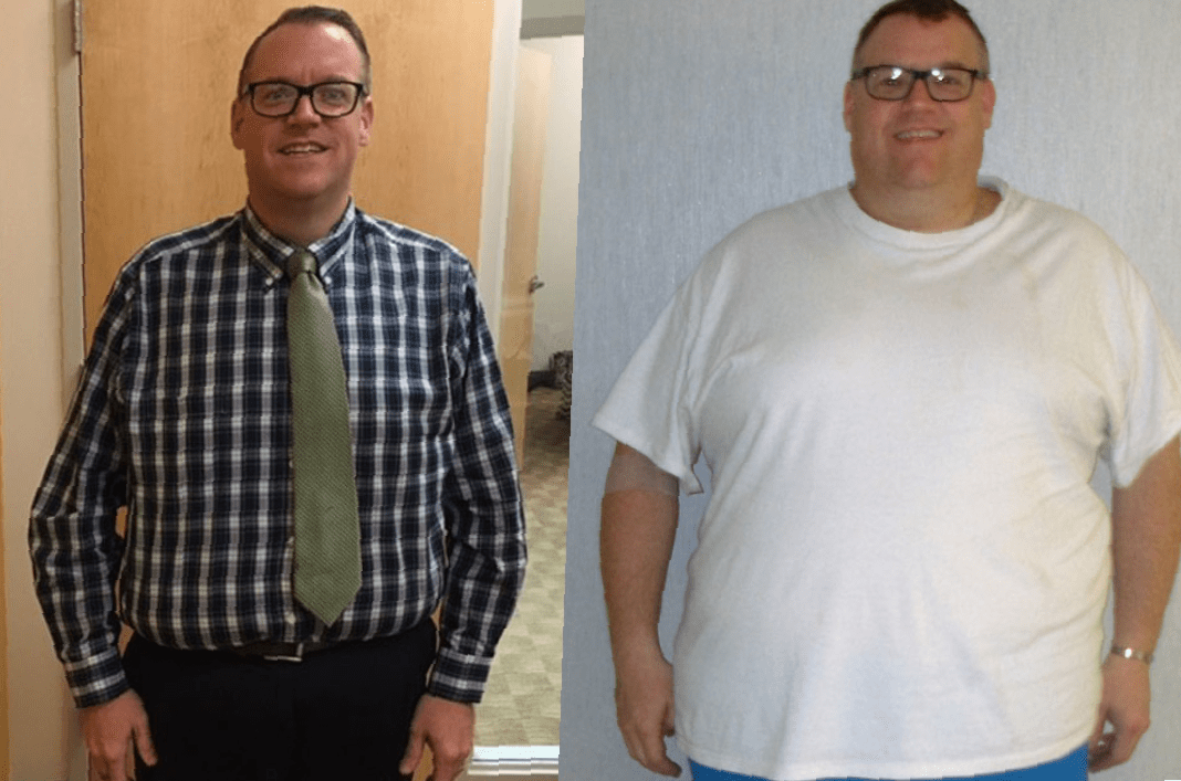 gastric-sleeve-before-and-after-3-months-6