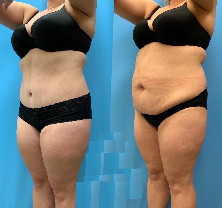 lipo-360-before-and-after-1