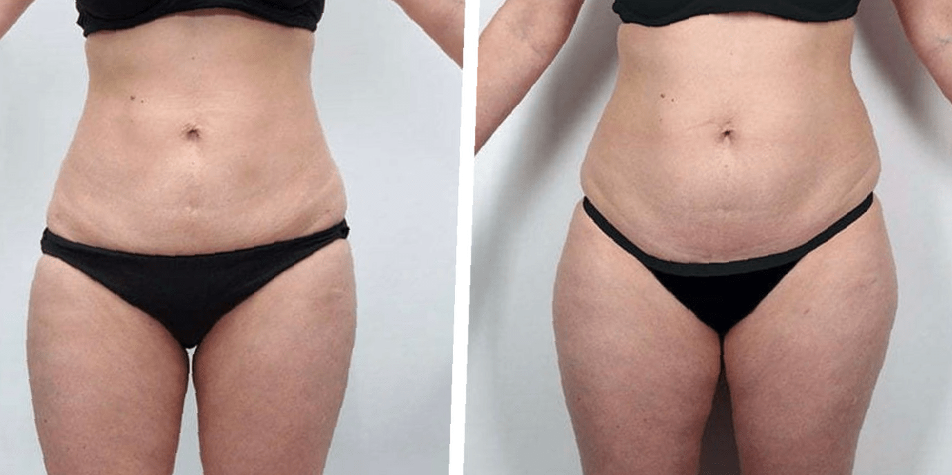 lipo-360-before-and-after-2