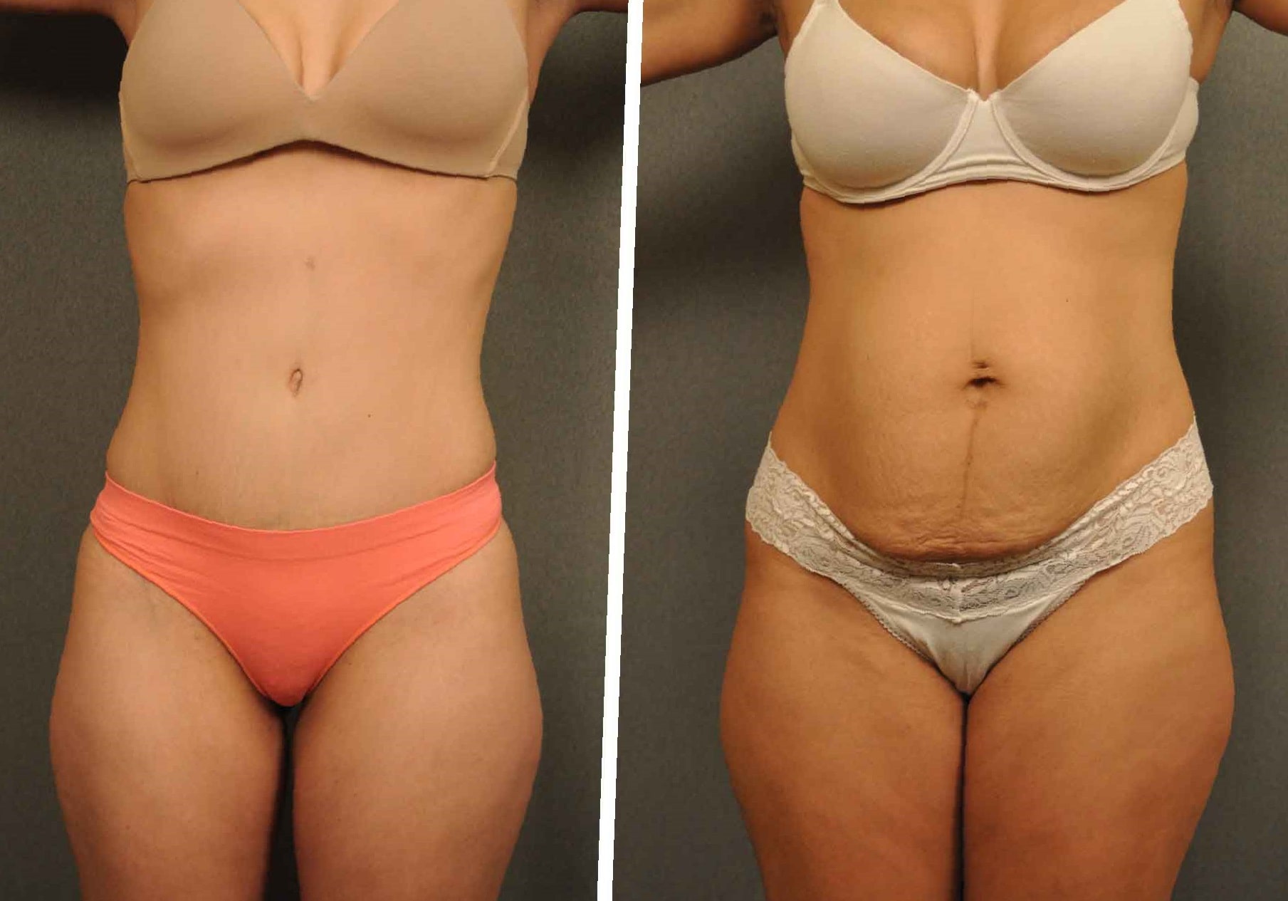 lipo-360-before-and-after-3