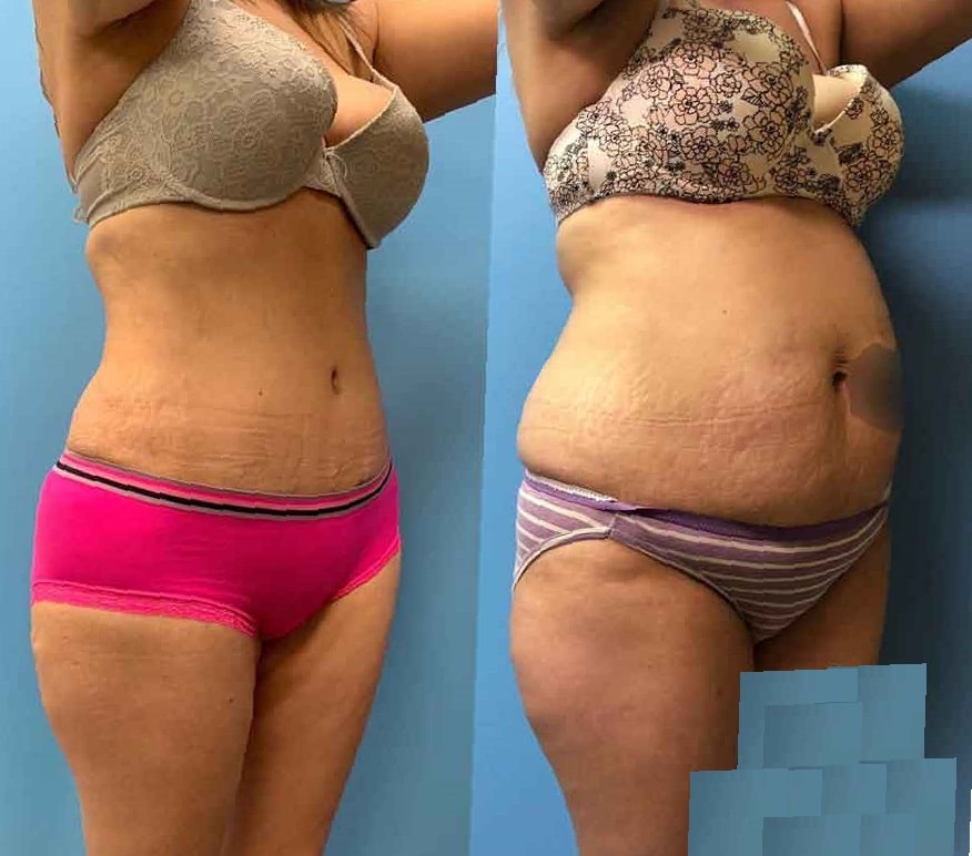 lipo-360-before-and-after-4