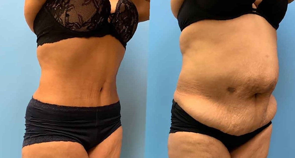 lipo-360-before-and-after-5