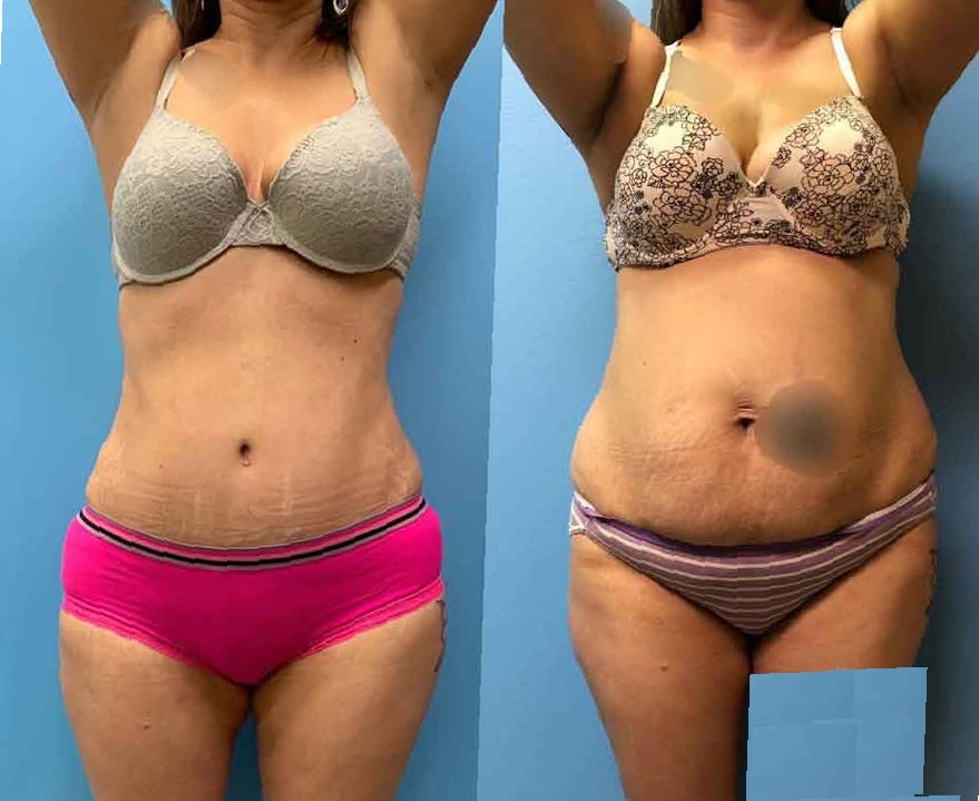 lipo-360-before-and-after-6