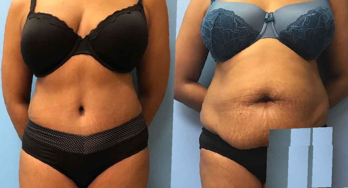 lipo-360-before-and-after-8