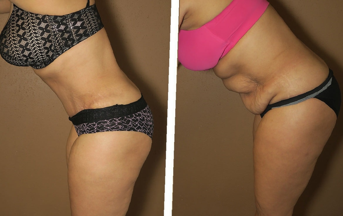 lipo-360-before-and-after-9