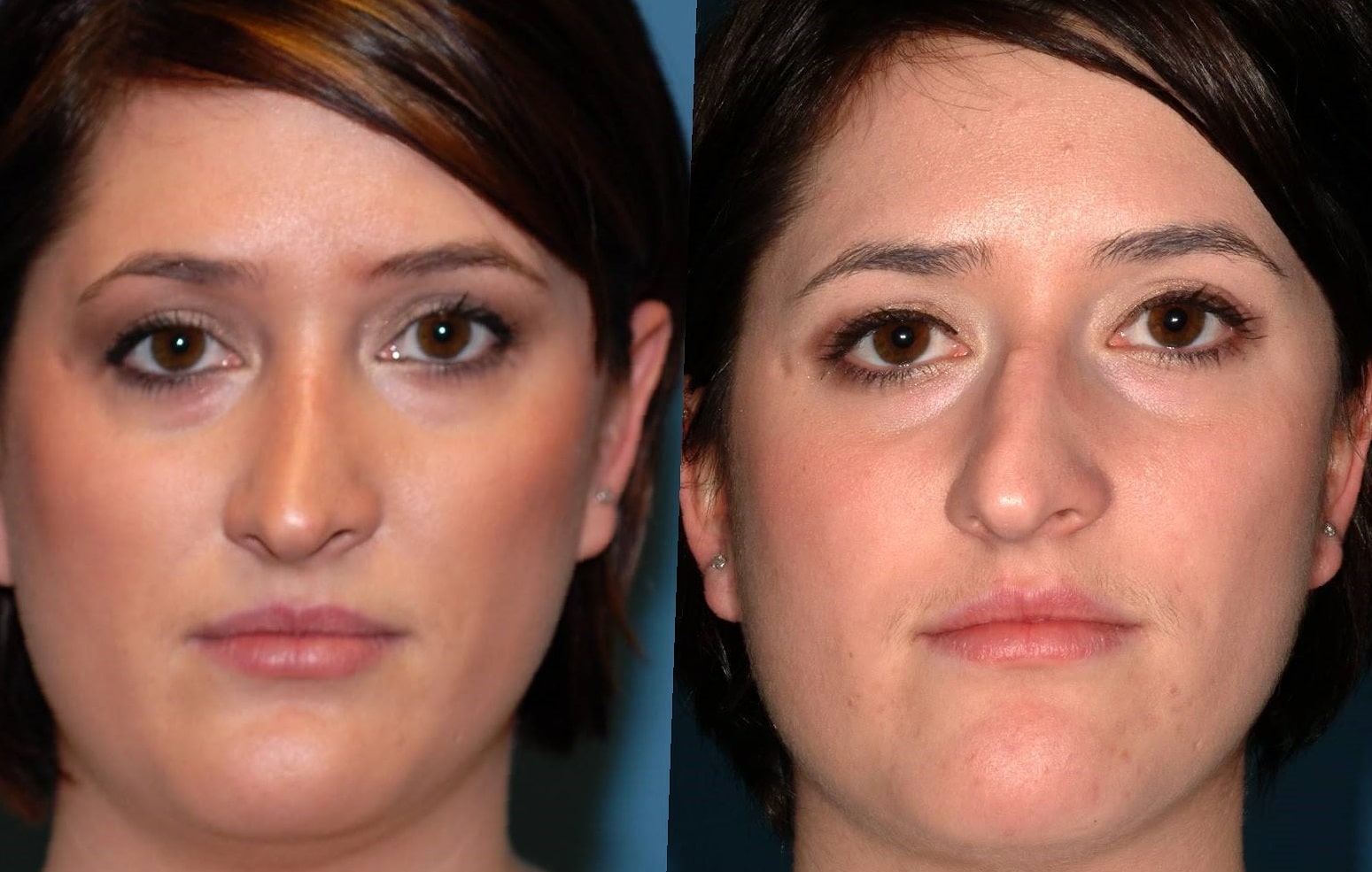 septoplasty-before-and-after-6