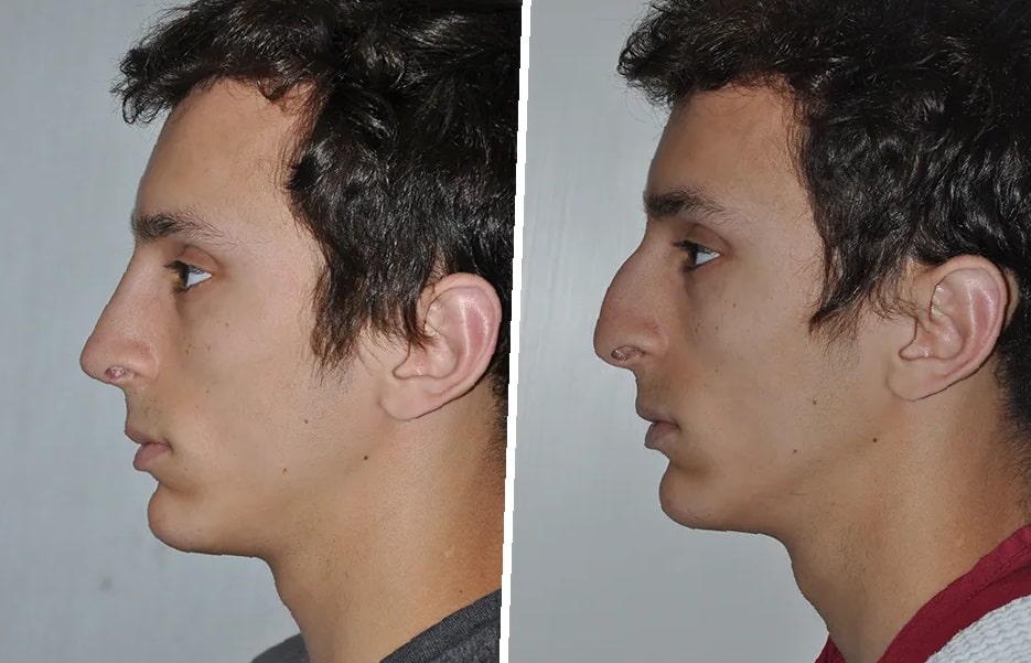 septoplasty-before-and-after-7
