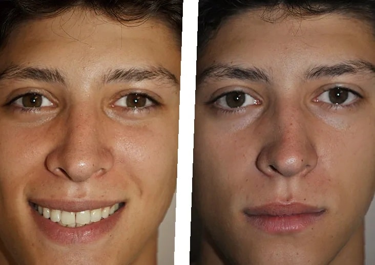 septoplasty-before-and-after-8