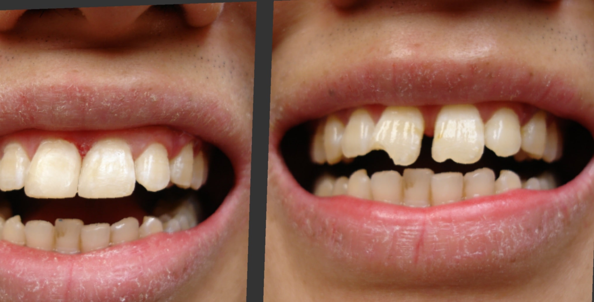 teeth-bonding-before-and-after-1