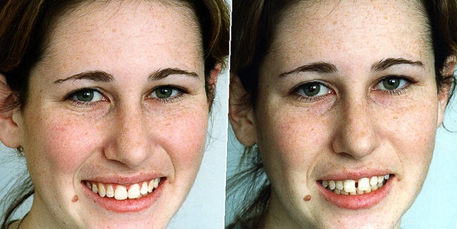teeth-bonding-before-and-after-10